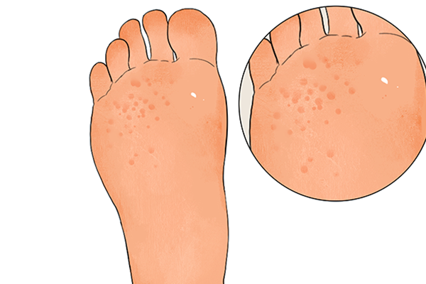 脚底脱皮吃什么维生素 脚底脱皮是怎么回事