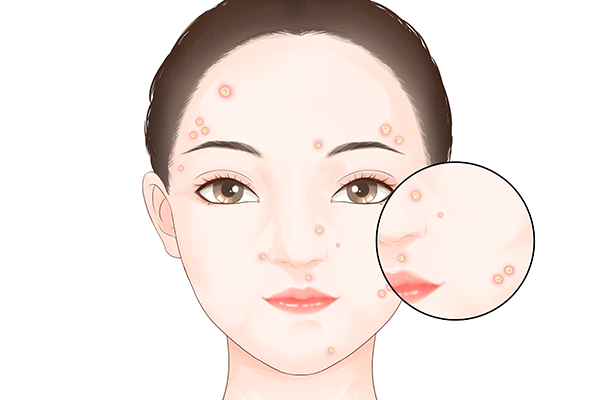 抵抗力低引起的皮肤病 抵抗力低引起的皮肤病是什么