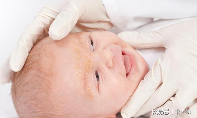 婴儿湿疹俗称奶癣，与真菌感染无关，做好清洁注意保湿是关键
