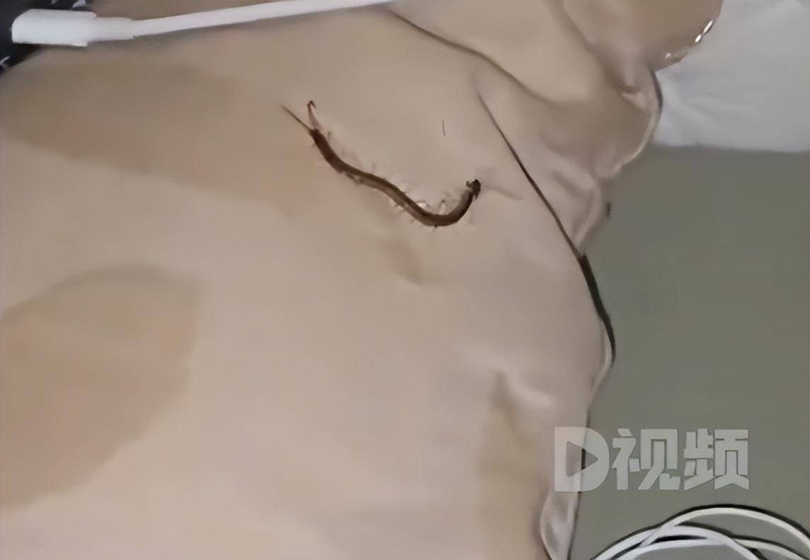 女子睡觉时被10厘米蜈蚣咬太阳穴